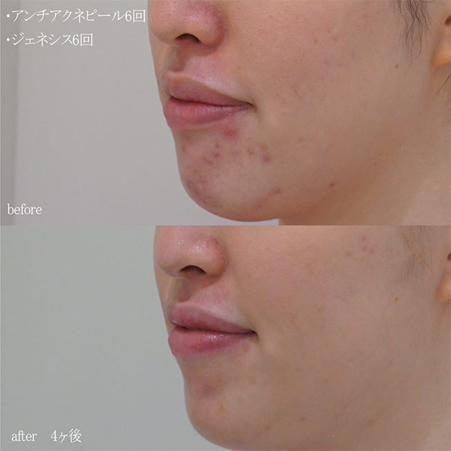画像:ピーリング治療を受けた患者様の症例画像