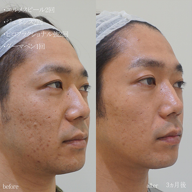 画像：実際に当院で毛穴治療を受けた患者様の症例画像