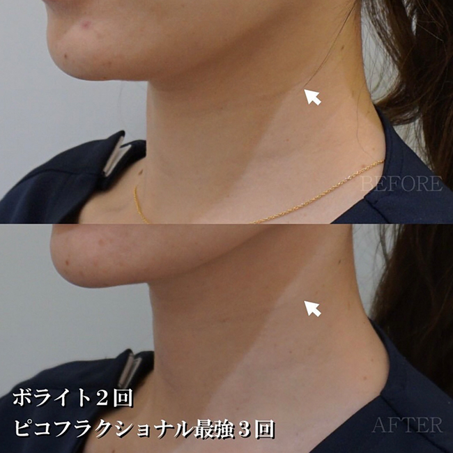 画像：実際に当院で毛穴治療を受けた患者様の症例画像