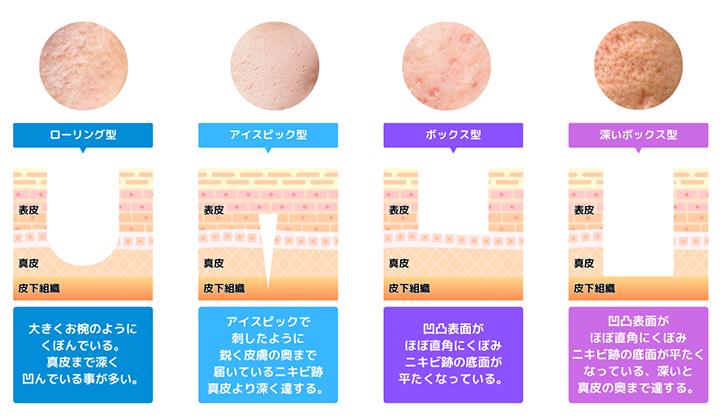 画像：クレーター