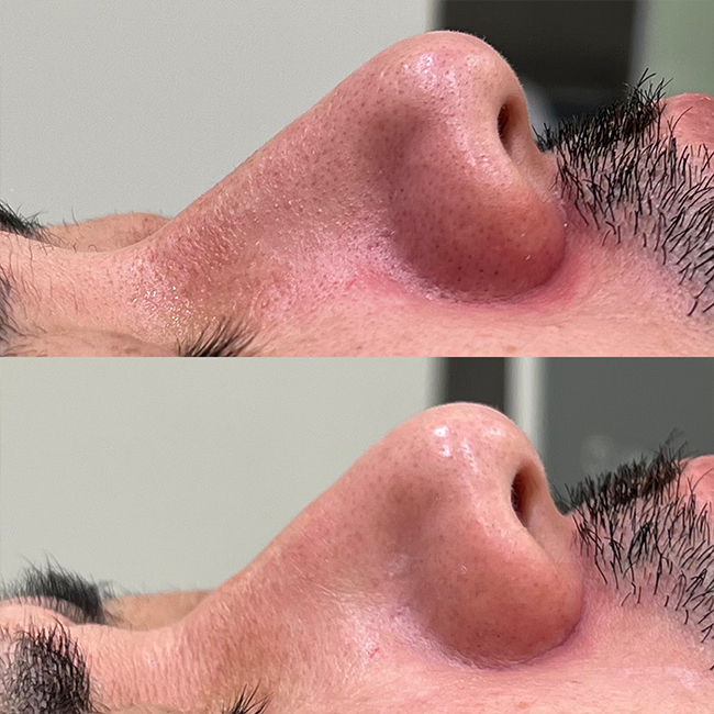 画像：実際に当院でピコフラクショナル治療、ピーリング＋ハイドラフェイシャル治療を受けた患者様の症例画像