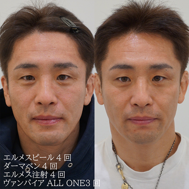 画像:目の下のシミ(老人性色素班)でお悩みの患者様