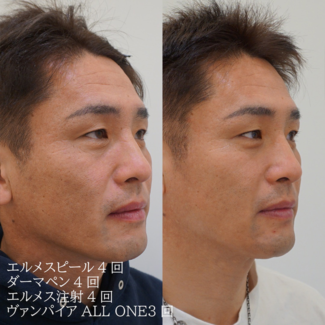 画像:目の下のシミ(老人性色素班)でお悩みの患者様