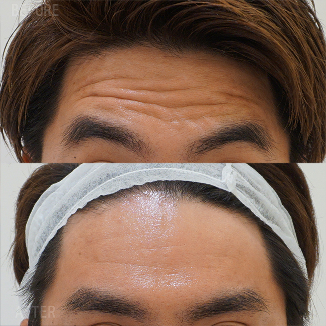 画像:老け顔(シワ)でお悩みの患者様