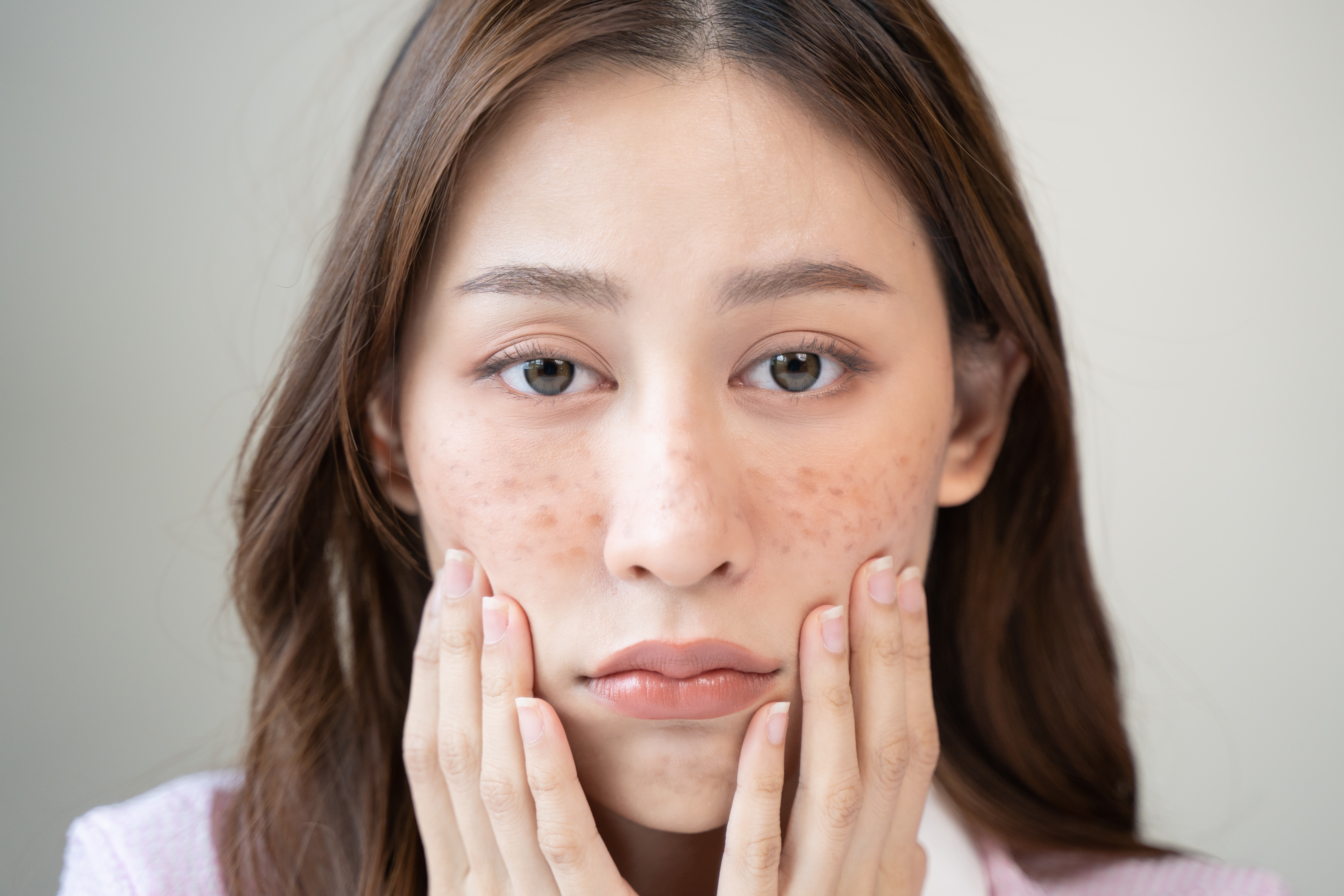 紫外線を浴びたら何年後にシミになる?